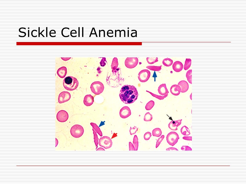 Sickle Cell Anemia